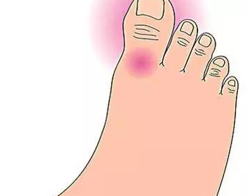 三大治疗急性痛风性关节炎的药物是什么?
